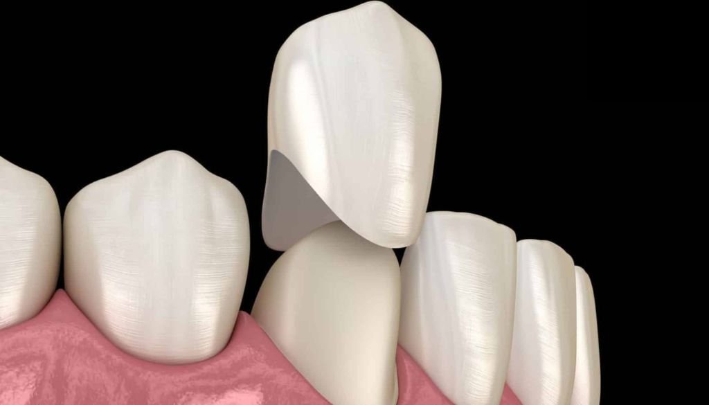 Can A Dental Crown Cause Tinnitus