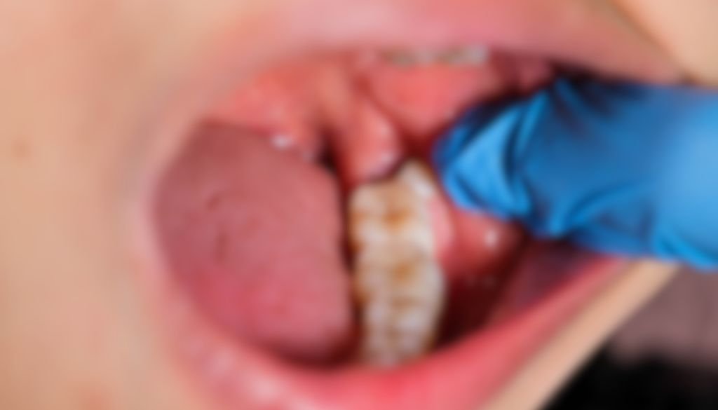 Can Wisdom Teeth Cause Tinnitus