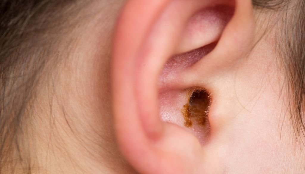 Will My Tinnitus Go Away After Removing Ear Wax